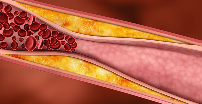 Deep Vein Thrombosis Or D