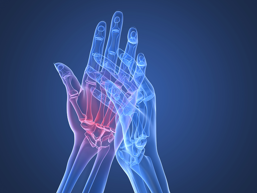 Rheumatoid Arthritis 