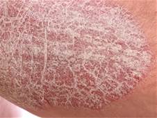 Psoriasis